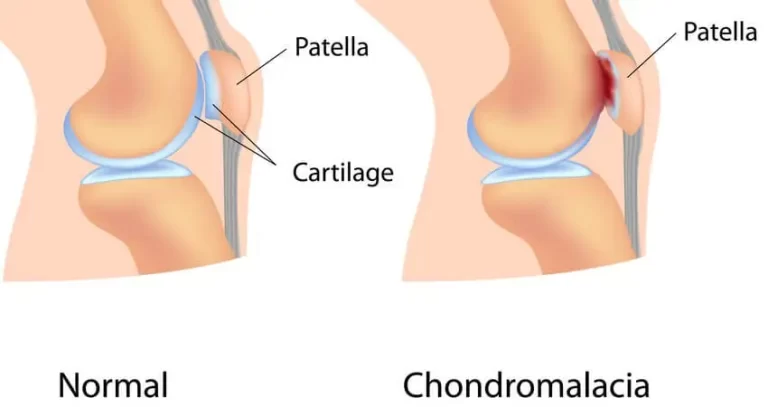Chondromalacia Patella and Physiotherapy Management