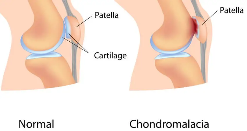 Chondromalacia patella