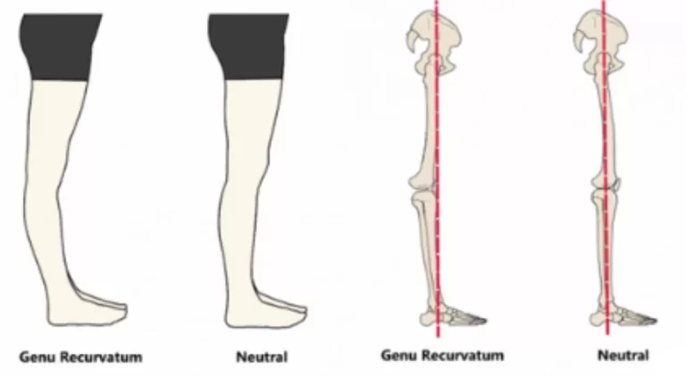 Genu Recurvatum and Physiotherapy Treatment