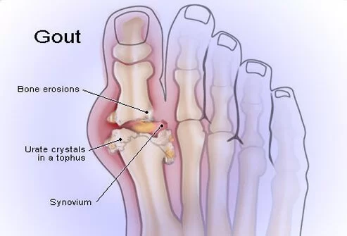 Gout and Physiotherapy Treatment