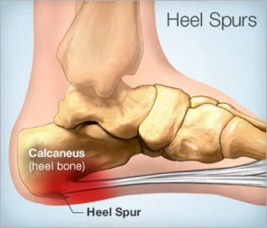 Heel Spur and Physiotherapy Management