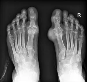 gout feet xray