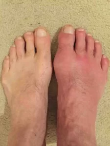 gout feet