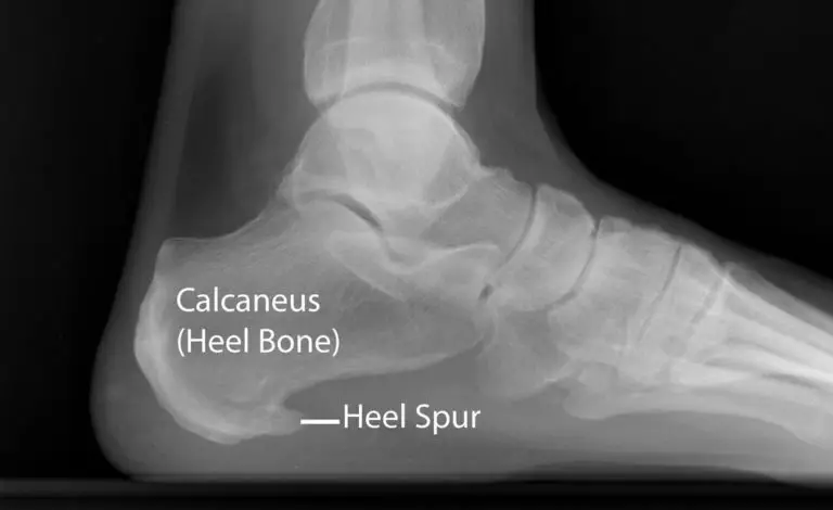 heel spur in x-ray