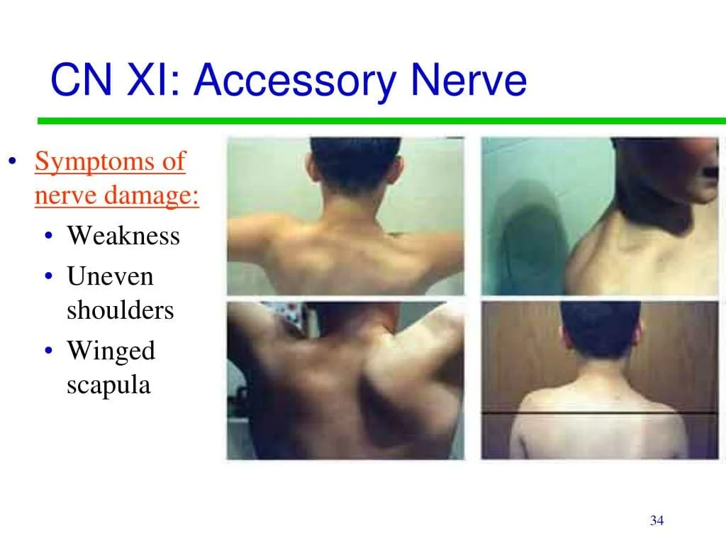 Accessory nerve damage