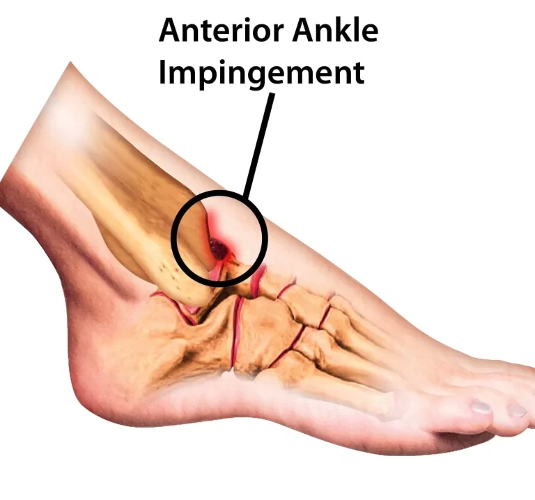 Anterior Ankle Impingement and Physiotherapy Management