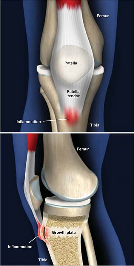 Osgood Schlatter’s Disease and Physiotherapy Management