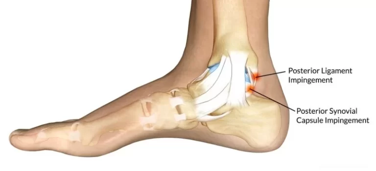 Posterior Ankle Impingement and Physiotherapy Management