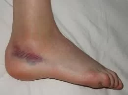 SWELLING AND BRUISE OF ANKLE SPRAIN