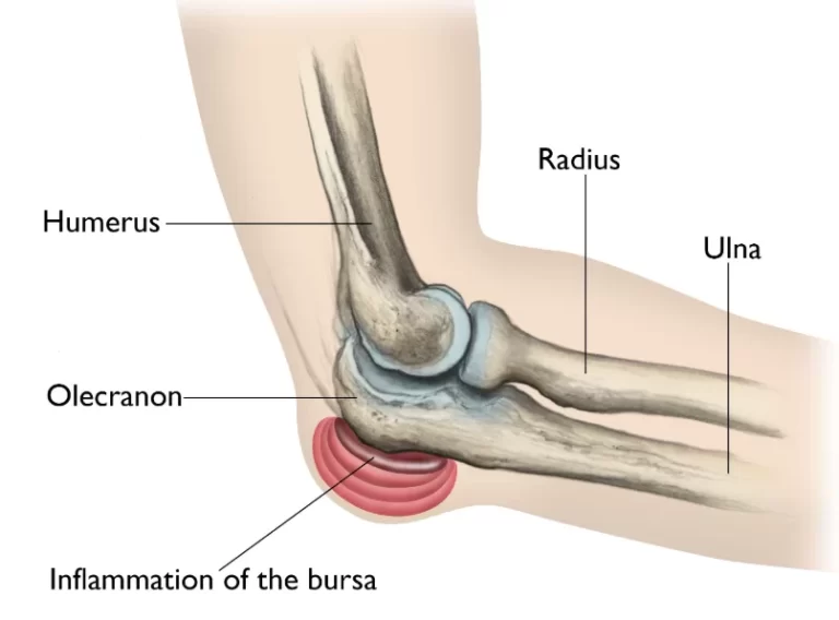 Students’ elbow and Physiotherapy management