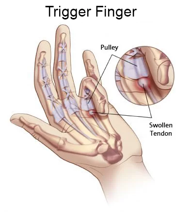 Trigger finger and Physiotherapy Management