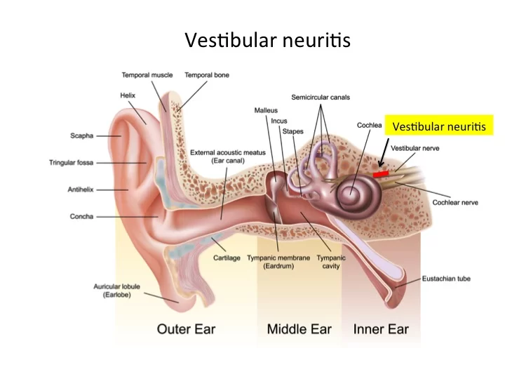 Vestibular neuritis