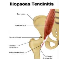 Iliopsoas tendonitis