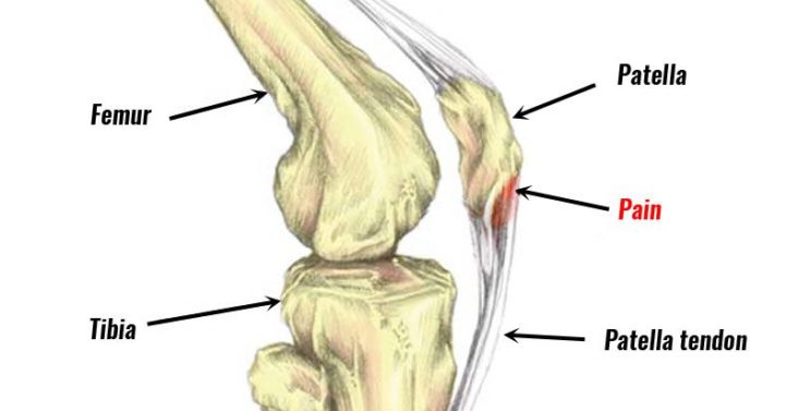 Patellar Tendinitis Cause Symptoms Treatment Exercise 3498