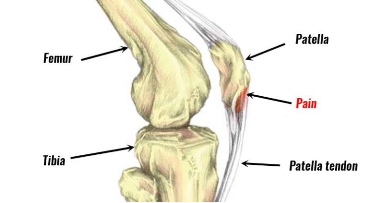Patellar Tendinitis and  Physiotherapy Treatment