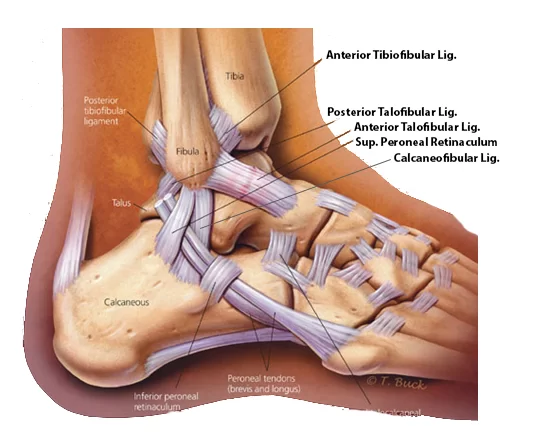 Ankle lateral ligament injury