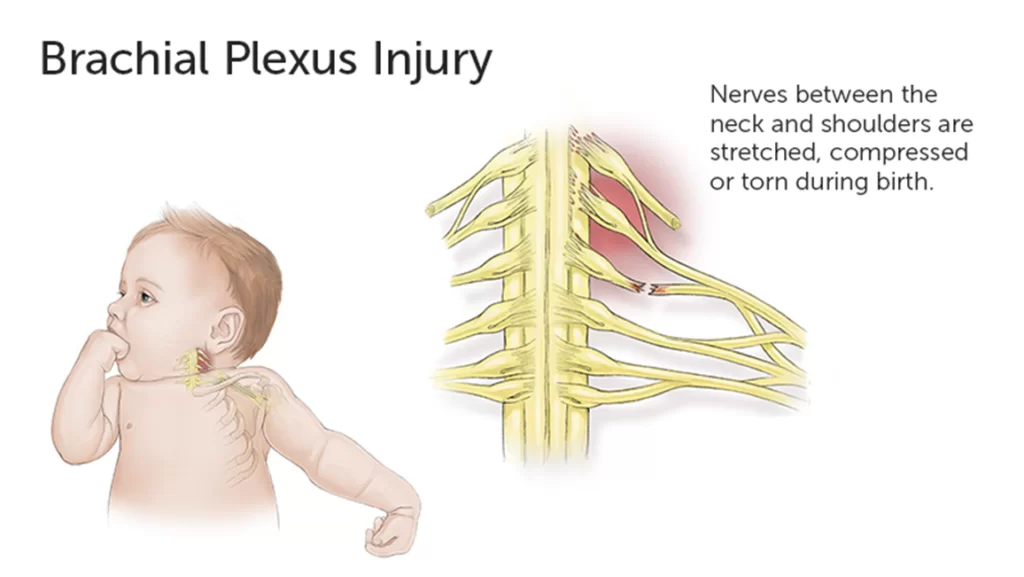 Brachial plexus injury during Child Birth