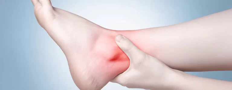 Rheumatoid Arthritis of Ankle and Physiotherapy Treatment