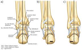 Subtalar joint arthritis: Causes, Symptoms, Diagnosis & Treatment