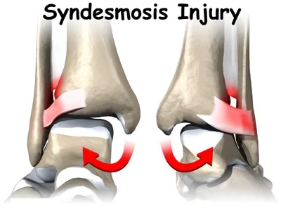 Syndesmotic ankle injury