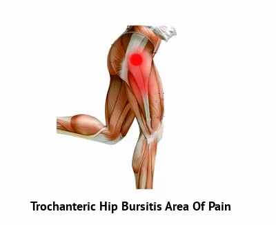 Trochanteric Hip bursitis area of pain