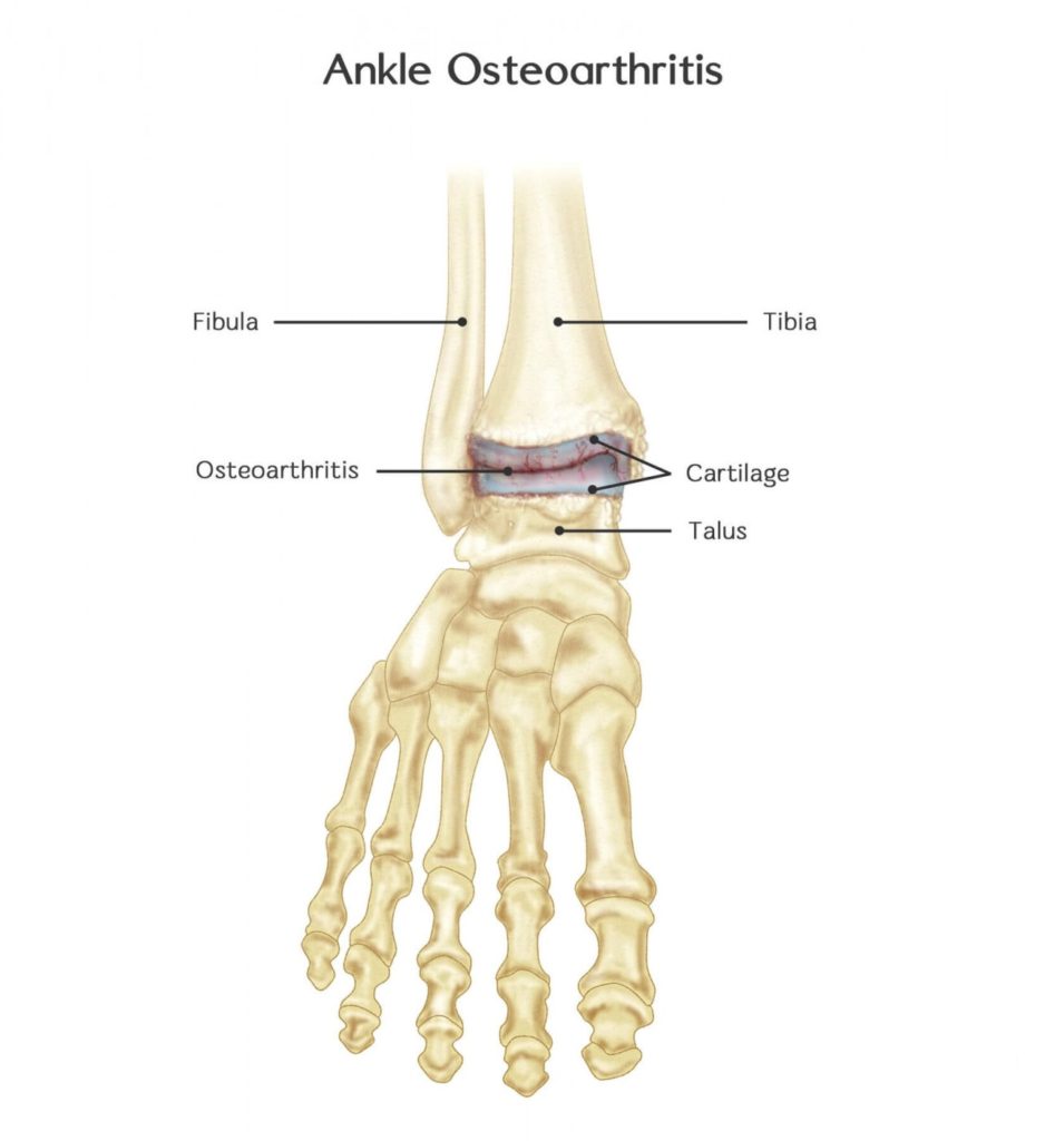 ankle osteoarthritis and physiotherapy treatment