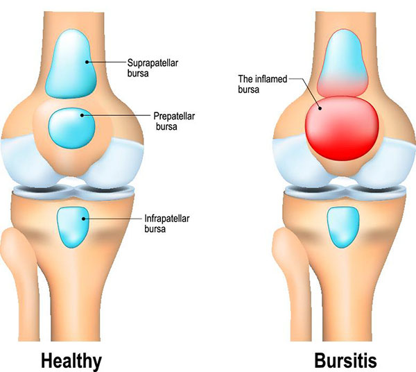 Bursitis and Physiotherapy Treatment