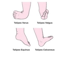 Ankle foot examination : observation, palpation & special test