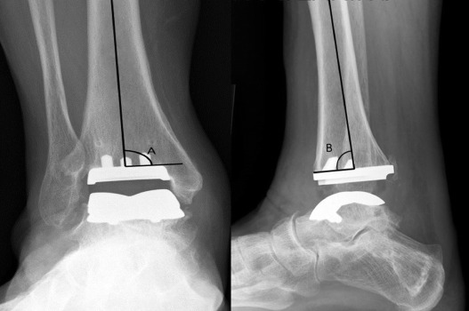 ankle arthroplasty