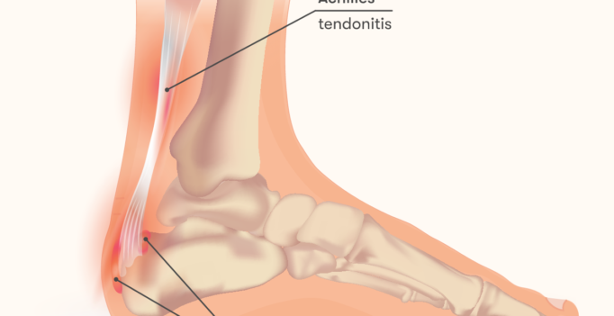 anterior achilles tendon bursitis