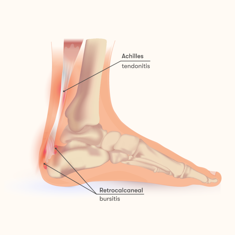 Retrocalcaneal bursitis and Physiotherapy management