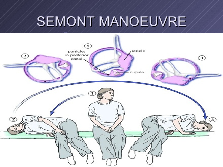 samont maneuver