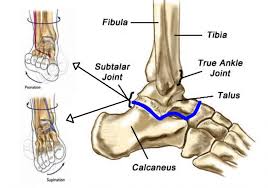 Subtalar joint arthritis