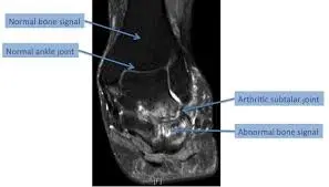 subtalar joint arthritis MRI