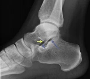 subtalar joint arthritis x-ray
