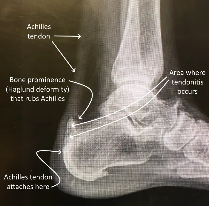 Achilles tendonitis X-Ray
