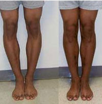 knee varus deformity