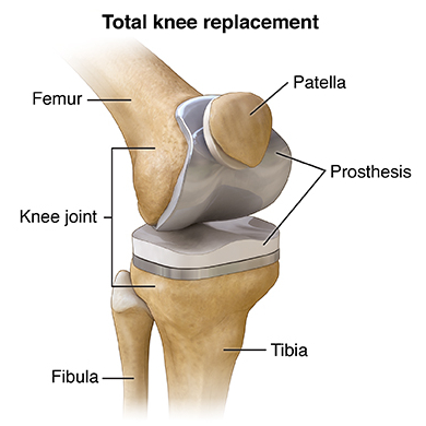 Knee joint Replacement