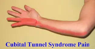 Pain area cubital tunnel syndrome