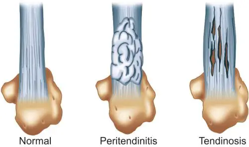 Peritendinitis and Paratendinitis
