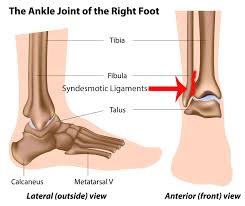 Syndesmotic Ankle Sprains