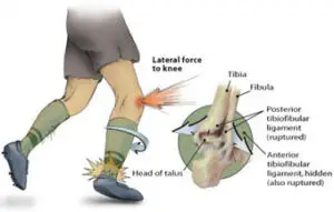 Syndesmotic Ankle Sprains of biomechanics