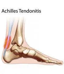 Tendon Achilles Tendonitis
