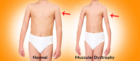 muscular dystropy
