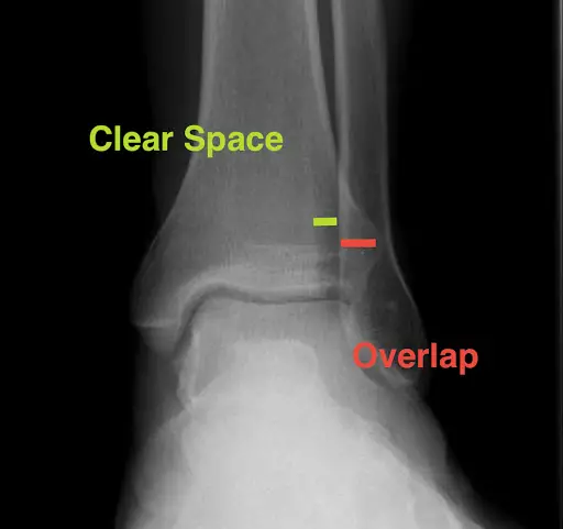 syndesmotic Ankle Sprains x-ray