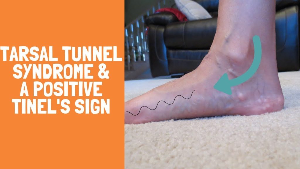 Tarsal tunnel syndrome Physiotherapy Management