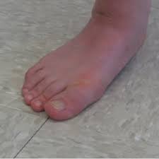 A severely pronated foot