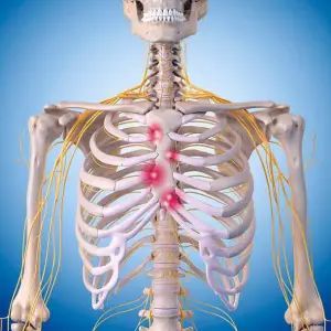 Costochondritis and Physiotherapy Management