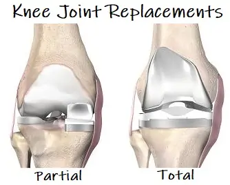 Knee Joint replacement