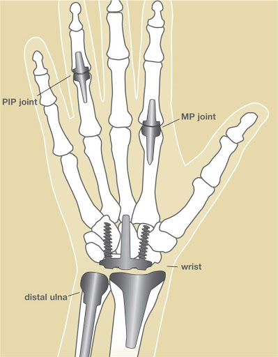 Finger and Wrist replacement